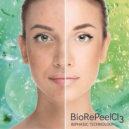 BioRePeel - Series of 4 treatments at Lush Skin Therapy in Mebane, NC